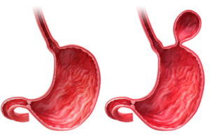 human stomach with hernia (Laparoscopic Hernia Repair)