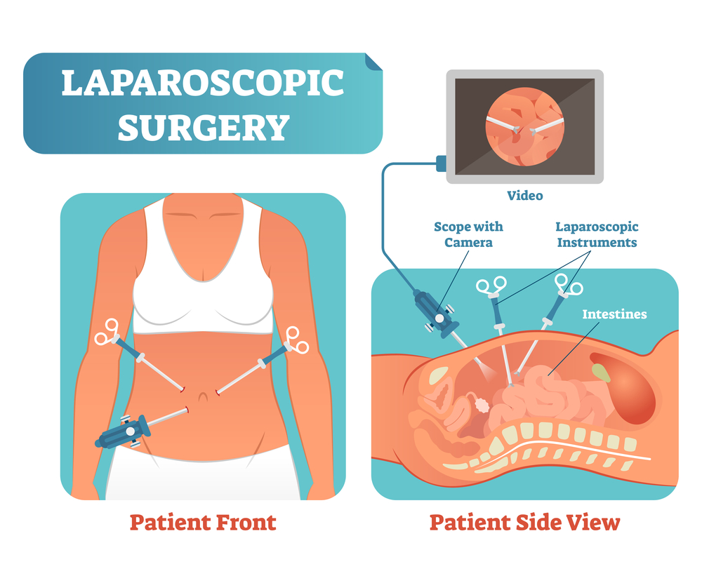 Orange County Laparoscopy Surgery Before and After Surgery Pictures