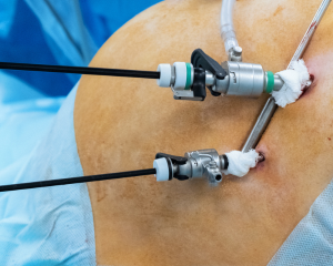 hernia repair surgery