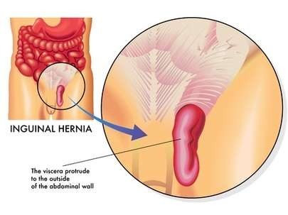 Inguinal Hernia - Dr. Abtin Khosravi’s OC Robotics Surgery, Orange County.